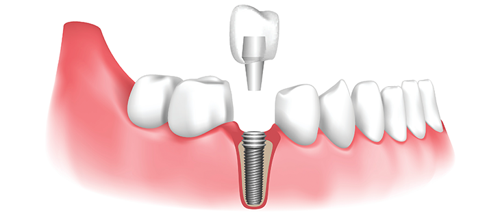 Budget-friendly dental implants near me