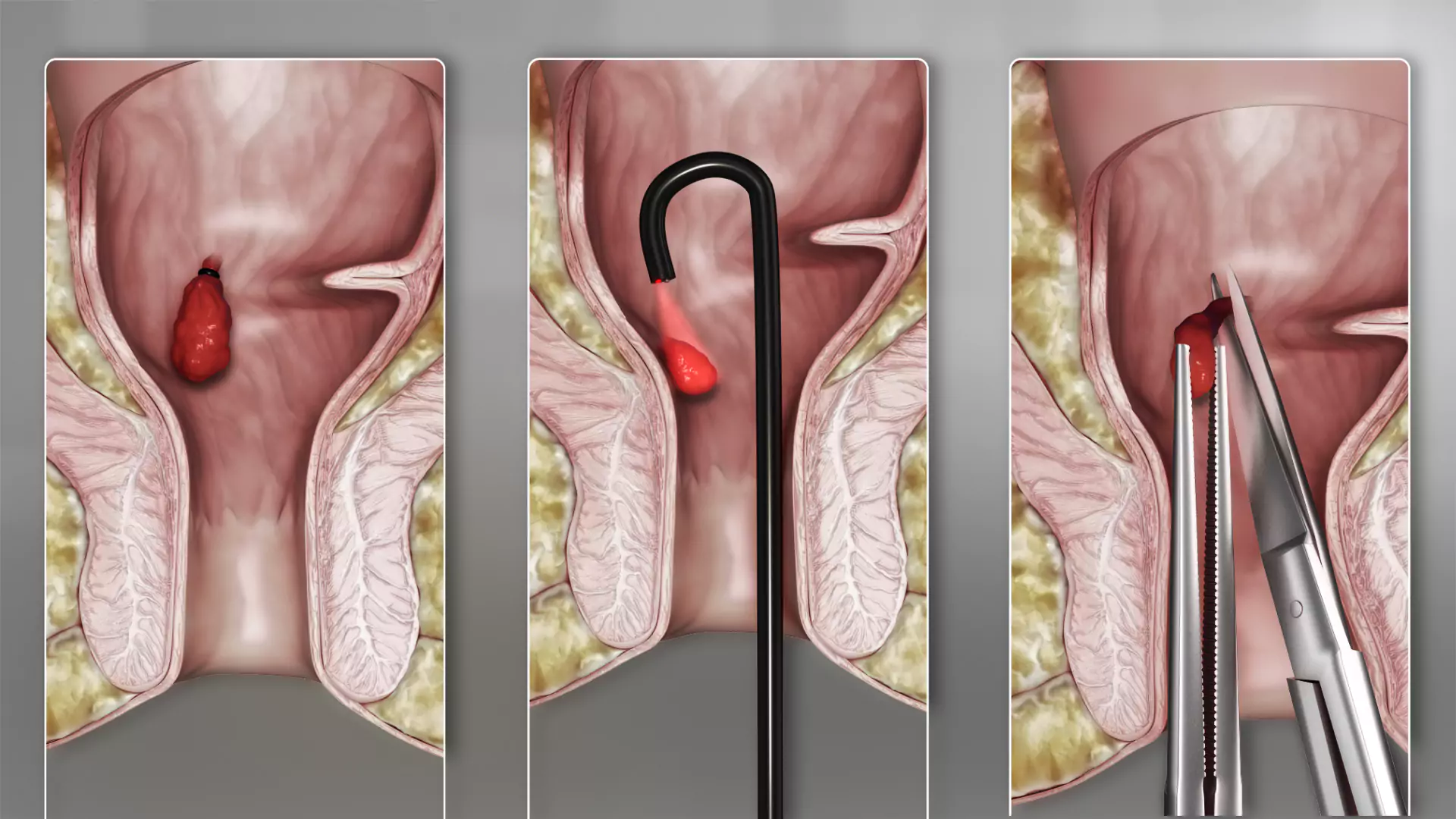 Piles surgeon near me