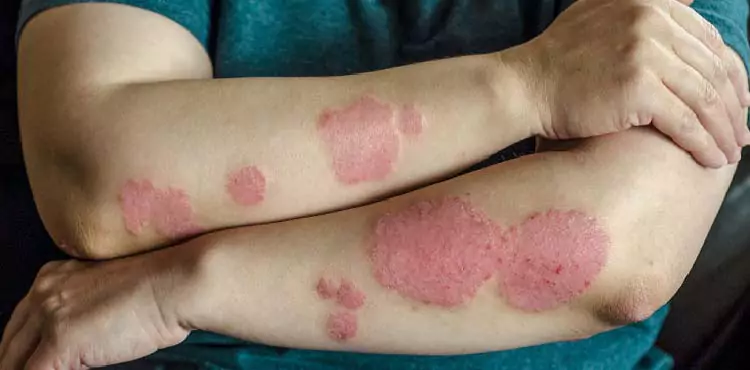 Best Psoriasis Doctor in Hyderabad