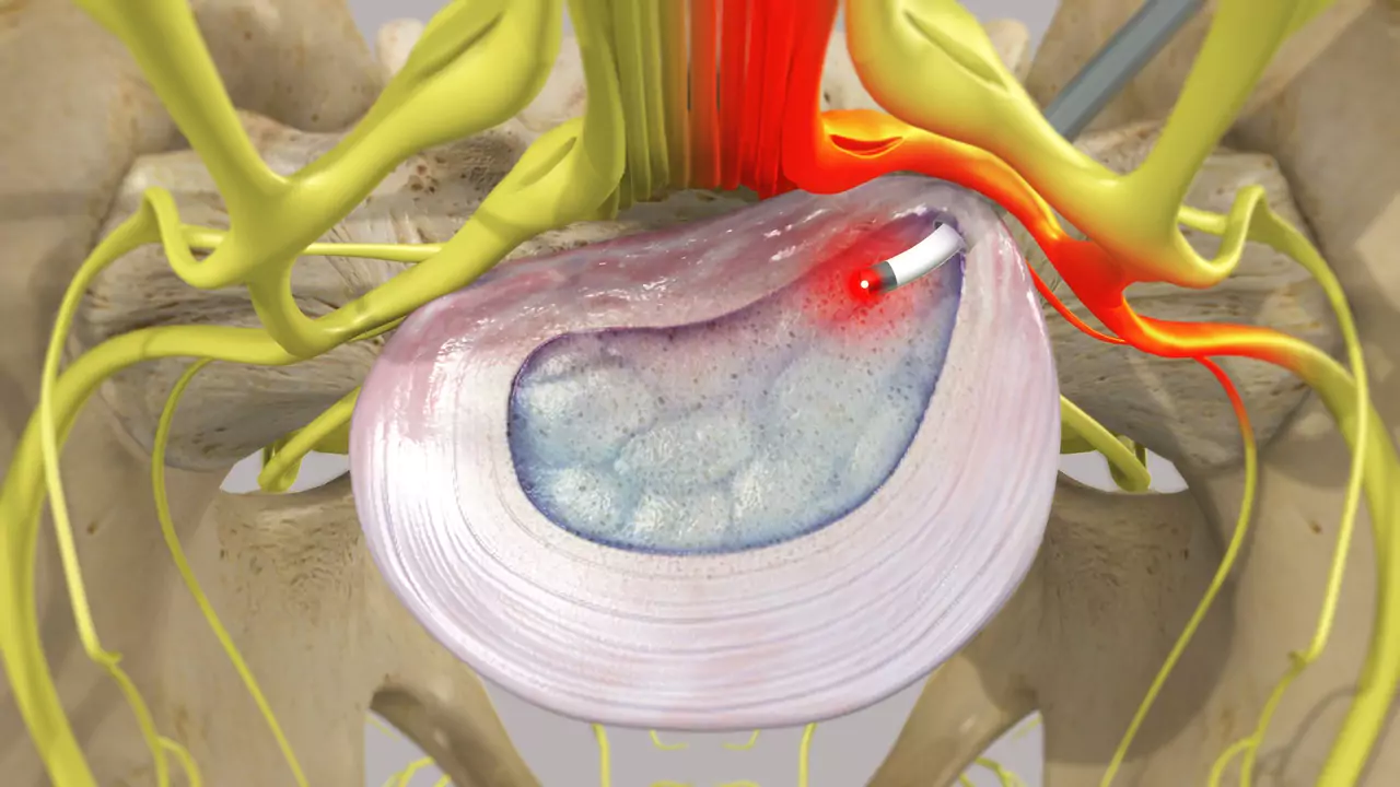 Sciatica surgery cost in Hyderabad