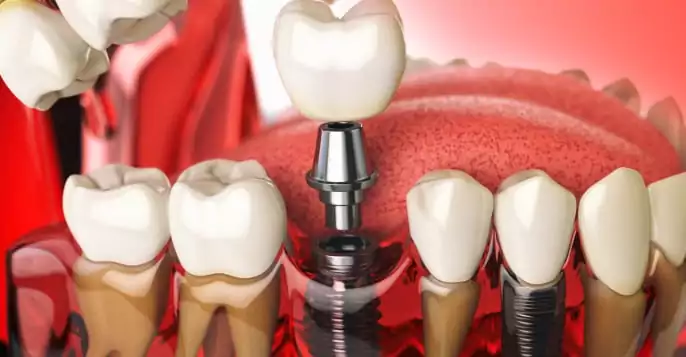 Budget-friendly dental implants near me