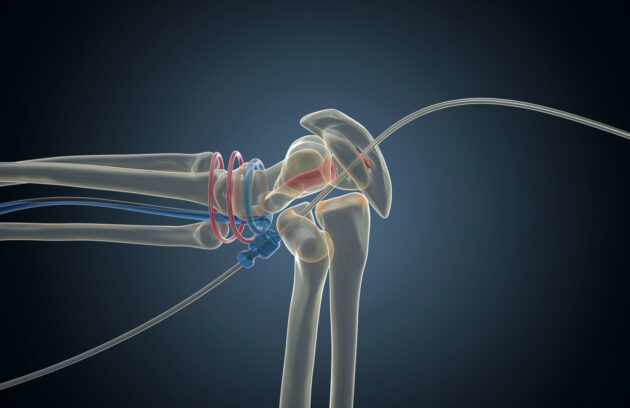 Advanced joint treatment at Top Orthopedic Hospital in Hyderabad